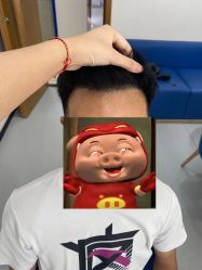 -大麦微针植发全国连锁