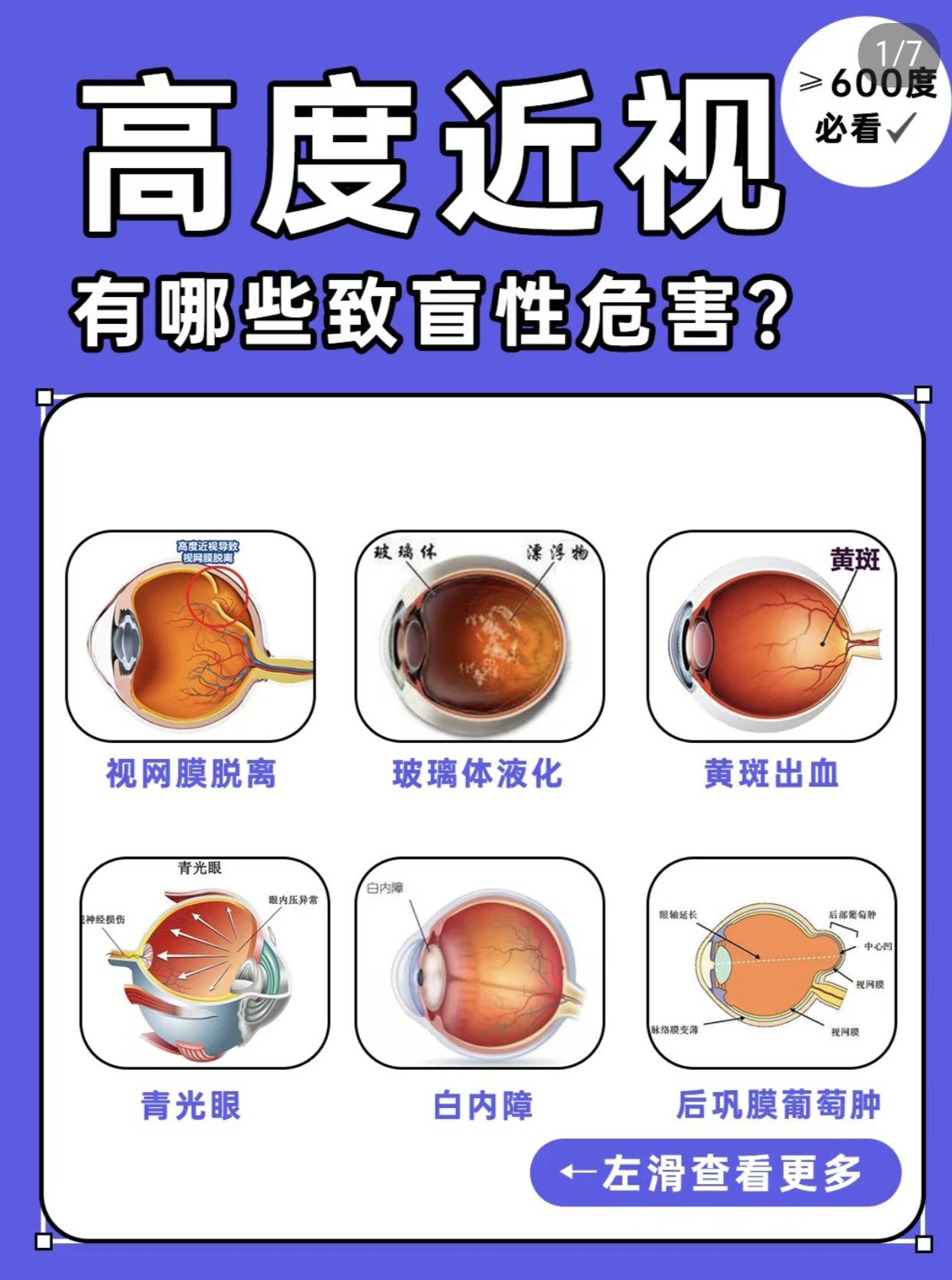 高度近视的危害,比你想象中更可怕
近