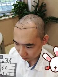 -大麦微针植发丨全国连锁