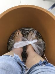 -派恩宜灰指甲鸡眼嵌甲手足癣