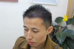 -大麦微针植发丨全国连锁