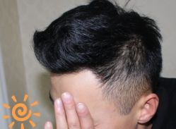 -大麦微针植发丨全国连锁