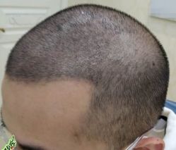 -大麦微针植发丨全国连锁