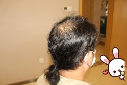 -大麦微针植发丨全国连锁