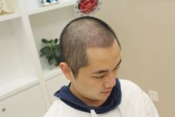 -大麦微针植发丨全国连锁