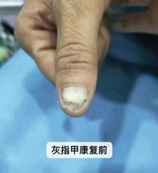 -德哥灰指甲脚气甲沟炎跖疣护理