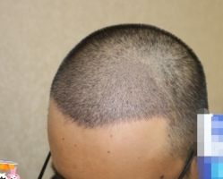 -大麦微针植发丨全国连锁