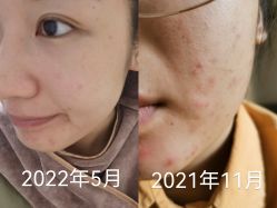 体验前-比华利美容医院