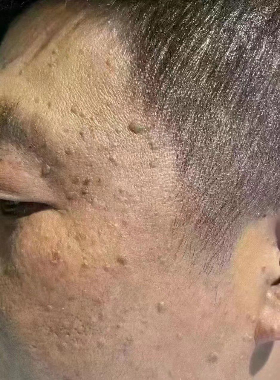 🌴不要让你的疣🦠
从1颗变成4颗