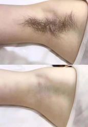 -薇兰专业脱毛连锁机构