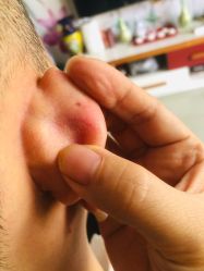 -痣斑堂·取大痣