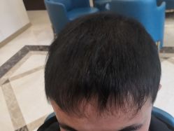 -碧莲盛·不剃发植发