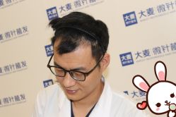 点击看大图 -大麦微针植发丨全国连锁