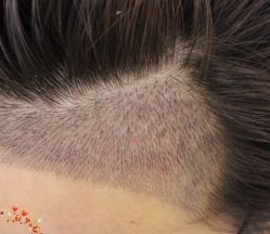 -大麦微针植发丨全国连锁