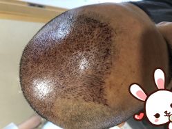 -大麦微针植发丨全国连锁