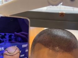 -碧莲盛·不剃发植发