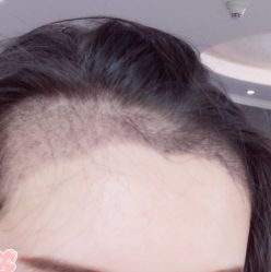 -大麦微针植发丨全国连锁