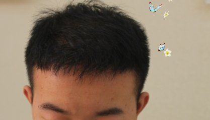 -大麦微针植发丨全国连锁