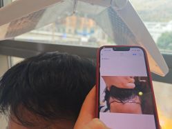 -碧莲盛·不剃发植发