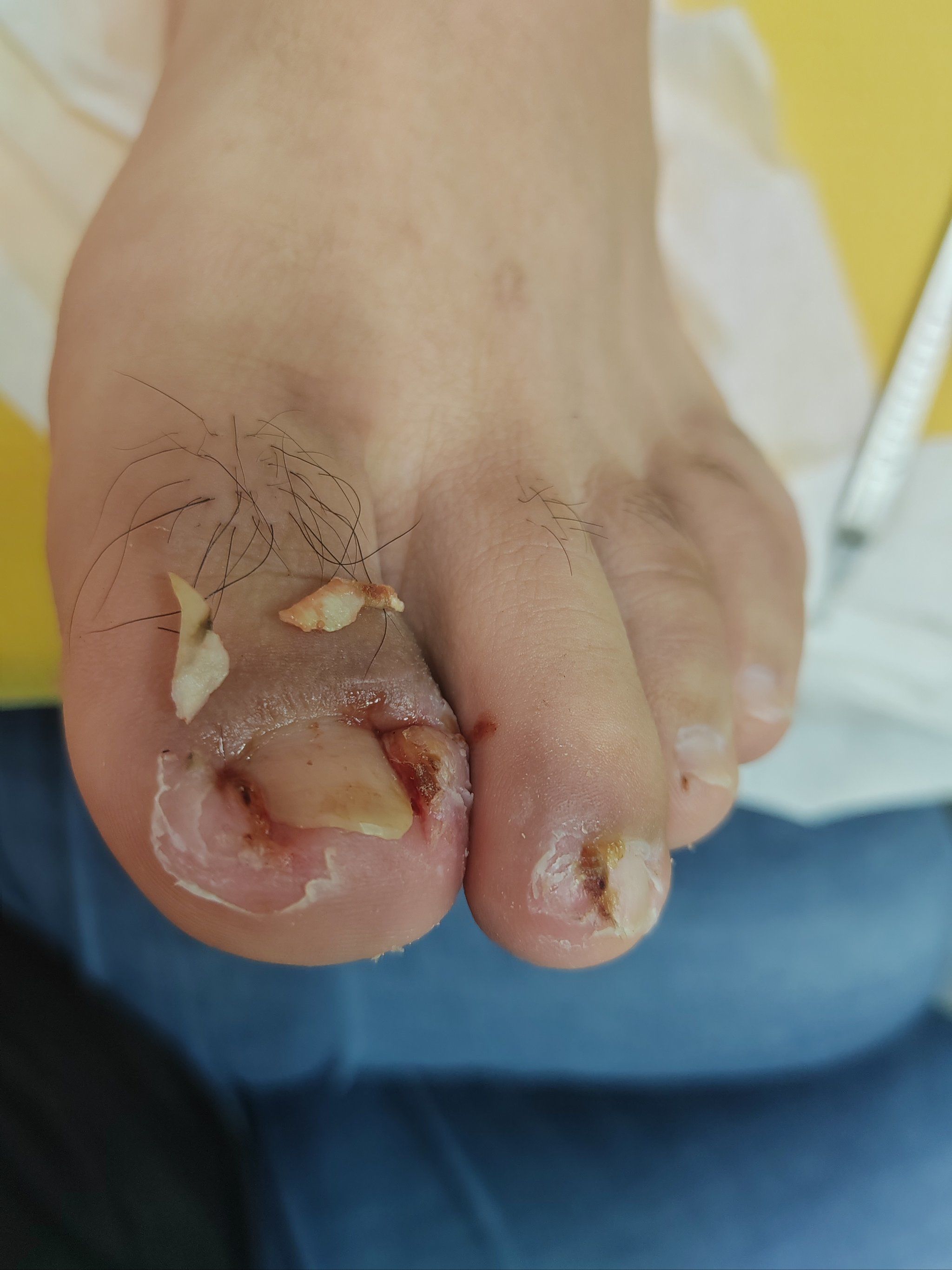 修脚划破会感染艾滋病吗