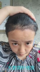 点击看大图 -大麦微针植发丨全国连锁