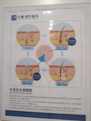 -大麦微针植发全国连锁