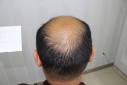 -大麦微针植发丨全国连锁