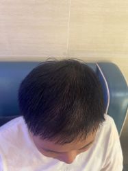 -大麦微针植发丨全国连锁