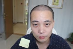 -大麦微针植发丨全国连锁