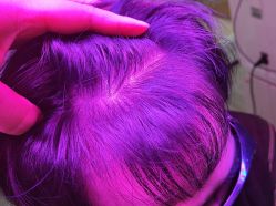 体验后-雍禾植发全国连锁