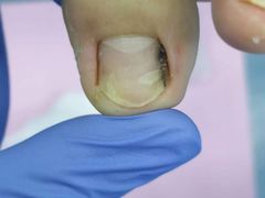 -Andrew指甲专科灰指甲·甲沟炎矫正·3D步态矫形鞋垫定制(上海法华镇路旗舰店)