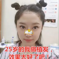 -碧莲盛·不剃发植发