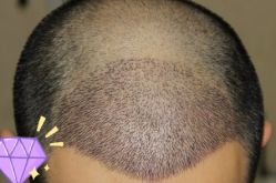 -大麦微针植发丨全国连锁