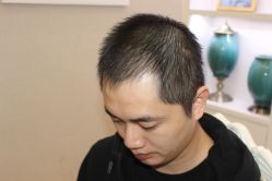 点击看大图 -大麦微针植发丨全国连锁