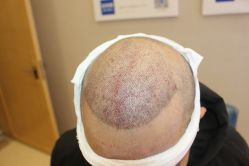 -大麦微针植发丨全国连锁