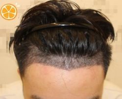 -大麦微针植发丨全国连锁