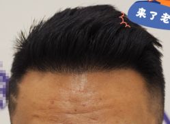 -大麦微针植发全国连锁