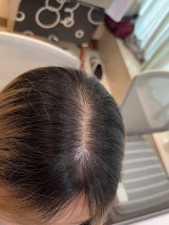 点击看大图 -碧莲盛·不剃发植发