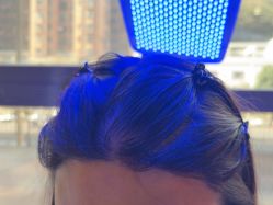 -碧莲盛·不剃发植发