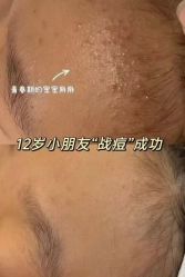 -瑶芳清颜草本祛痘