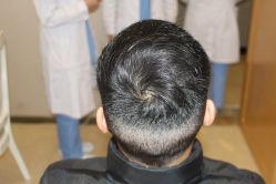 -大麦微针植发丨全国连锁