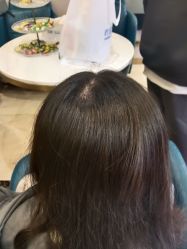 -碧莲盛·不剃发植发