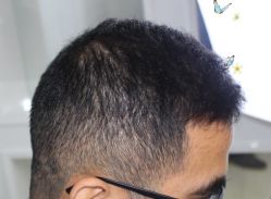 -大麦微针植发丨全国连锁