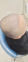 -大麦微针植发丨全国连锁