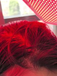 -碧莲盛·不剃发植发