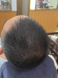 点击看大图 体验后-大麦微针植发全国连锁