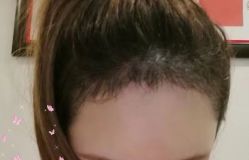 -大麦微针植发丨全国连锁