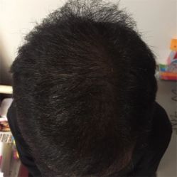 -碧莲盛·不剃发植发