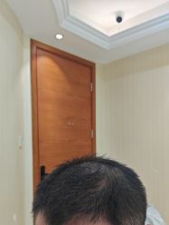 -碧莲盛·不剃发植发