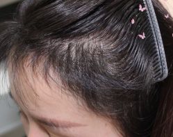 -大麦微针植发丨全国连锁